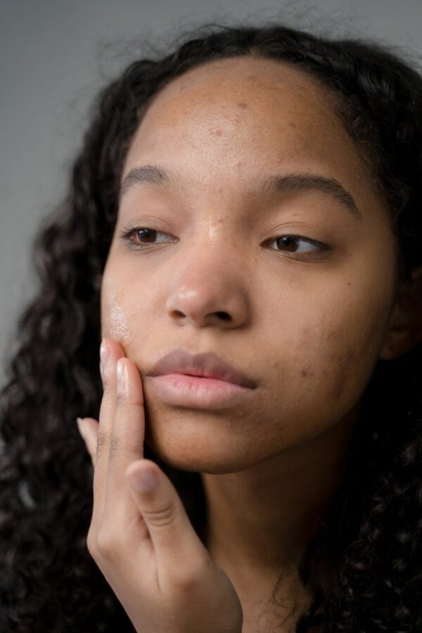 jeune femme peau matte acnée pexels-ron-lach