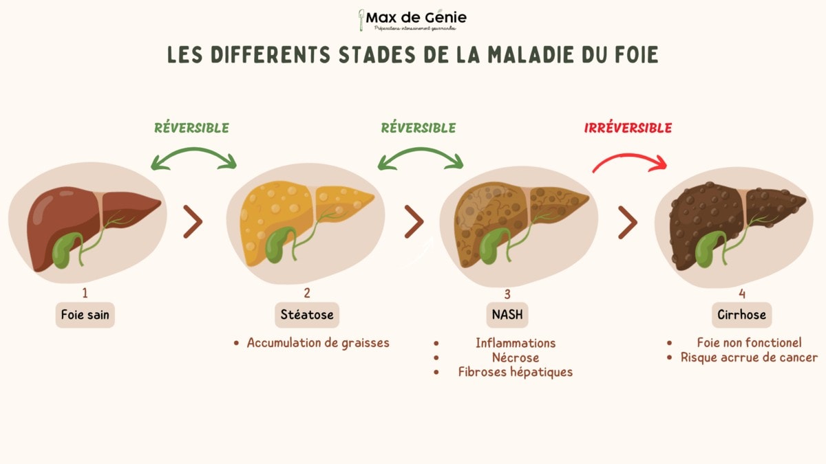 Les stades maladies foie